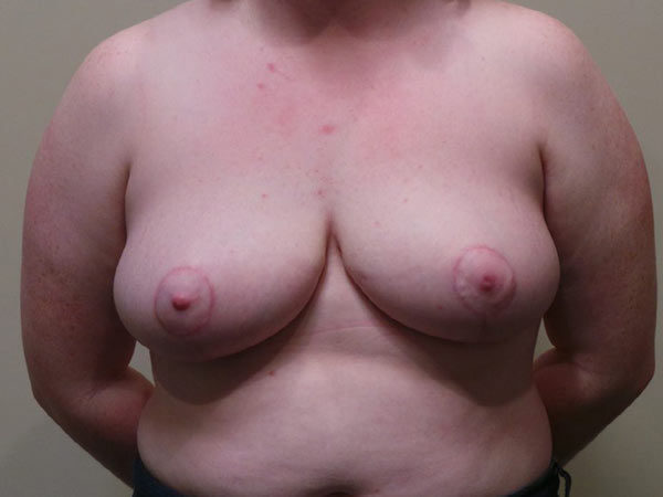 Breast Reduction Patient 03 After 1