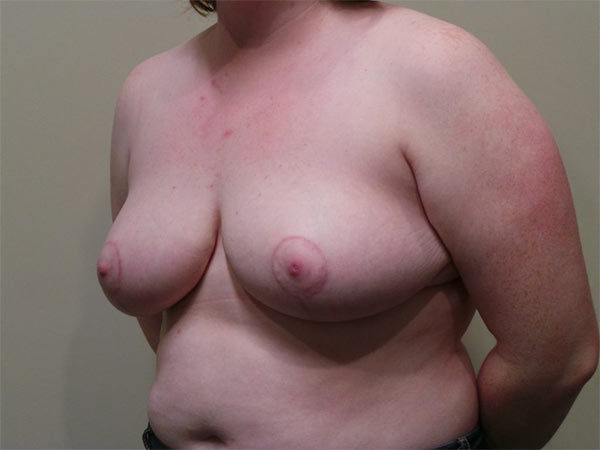 Breast Reduction Patient 03 After 2