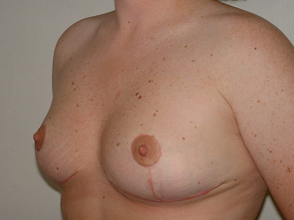 Breast Reduction Patient 10 After 2