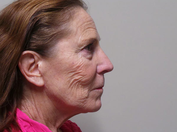 Brow Lift Patient 05 Before 2