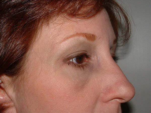 Brow Lift Patient 01 After 1