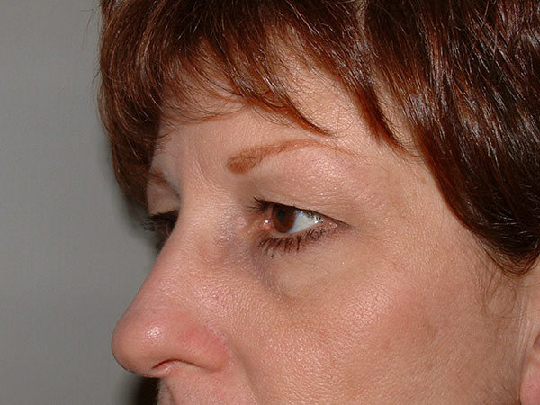 Brow Lift Patient 01 Before 2