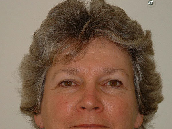 Brow Lift Patient 04 Before 1
