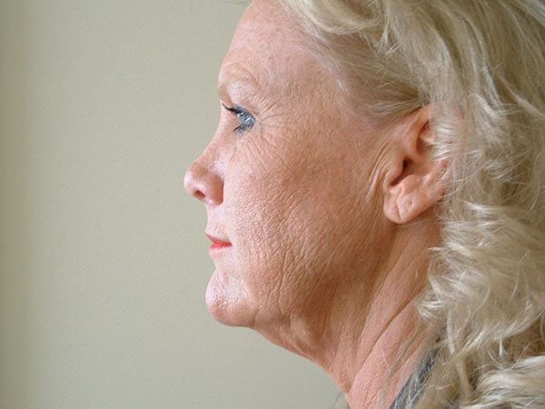 Brow Lift Patient 02 Before 1