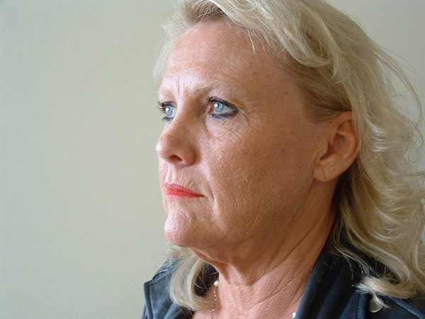 Brow Lift Patient 02 Before 2