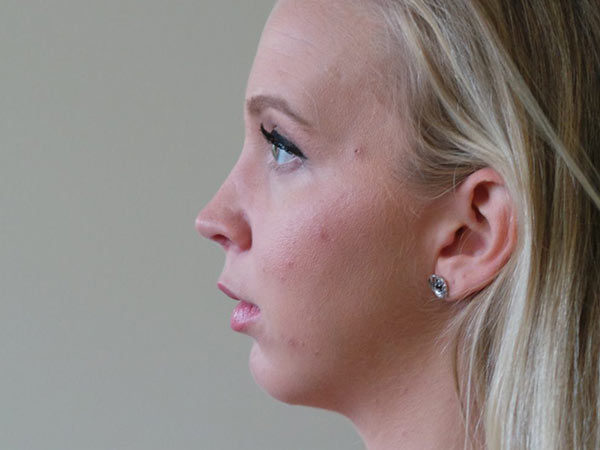 Chin Augmentation Patient 01 After 1