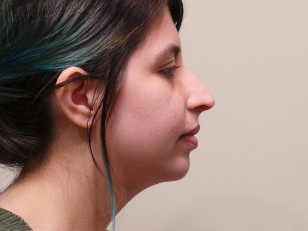 Chin Augmentation Patient 06 After 1