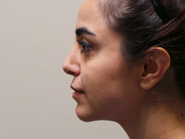 Chin Augmentation Patient 03 After 1