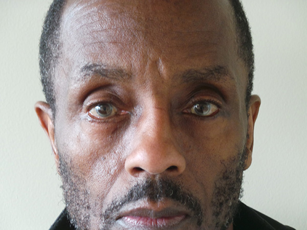 Eyelid Surgery Patient 23 After 1