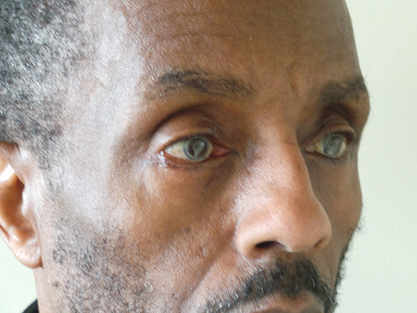 Eyelid Surgery Patient 23 After 2