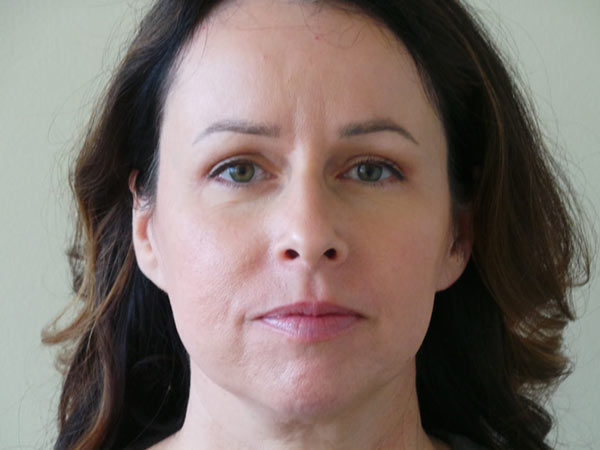 Eyelid Surgery Patient 01 After 2