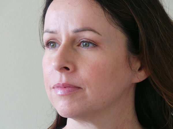 Eyelid Surgery Patient 01 After 1