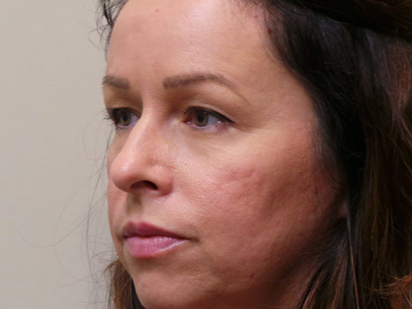 Eyelid Surgery Patient 01 Before 1