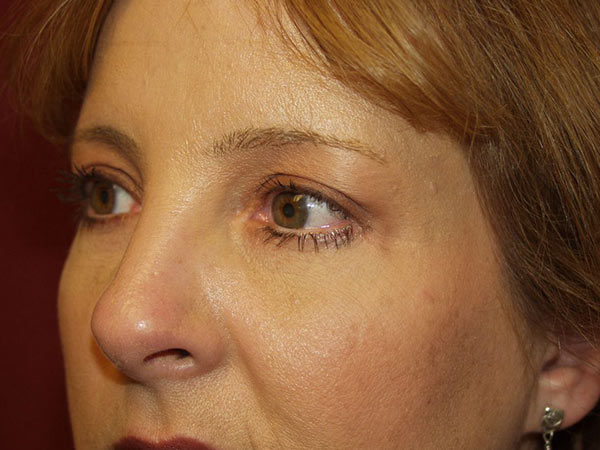 Eyelid Surgery Patient 12 After 2