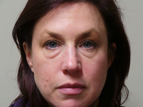 Eyelid Surgery Patient 13 Before 1