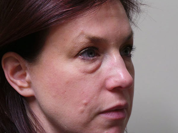 Eyelid Surgery Patient 13 Before 2