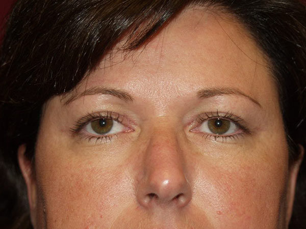 Eyelid Surgery Patient 15 After 1