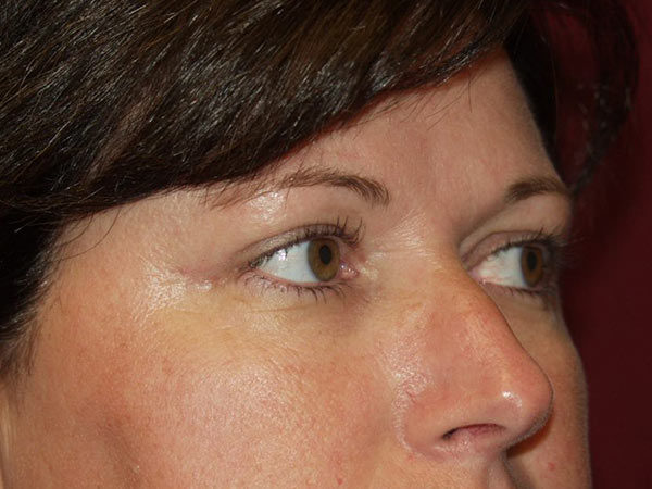 Eyelid Surgery Patient 15 After 2