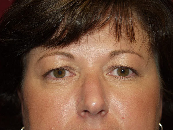 Eyelid Surgery Patient 15 Before 1