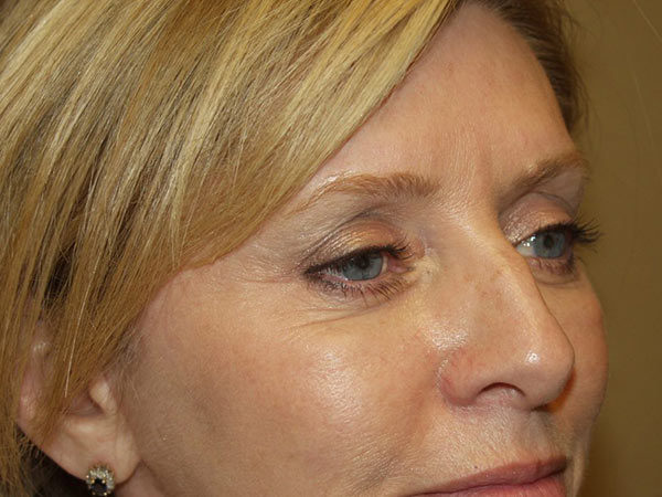 Eyelid Surgery Patient 21 After 2