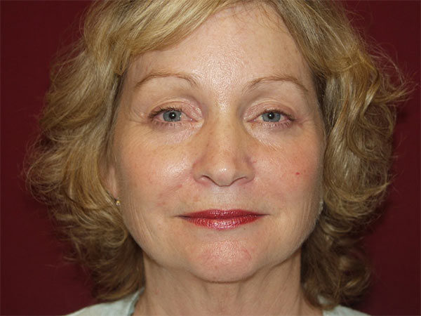 Eyelid Surgery Patient 21 After 1