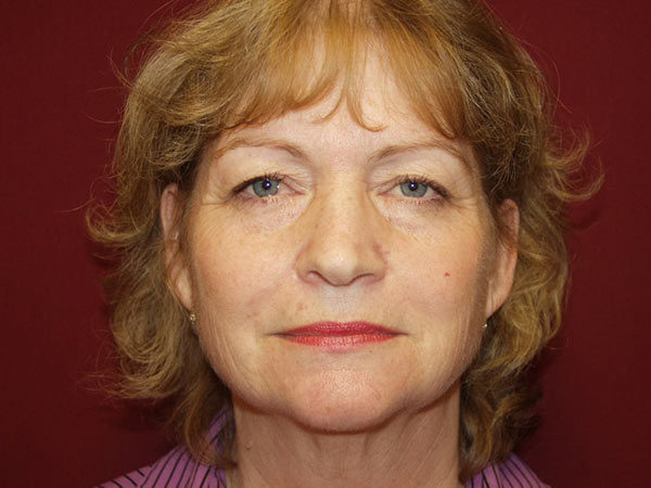 Eyelid Surgery Patient 21 Before 1