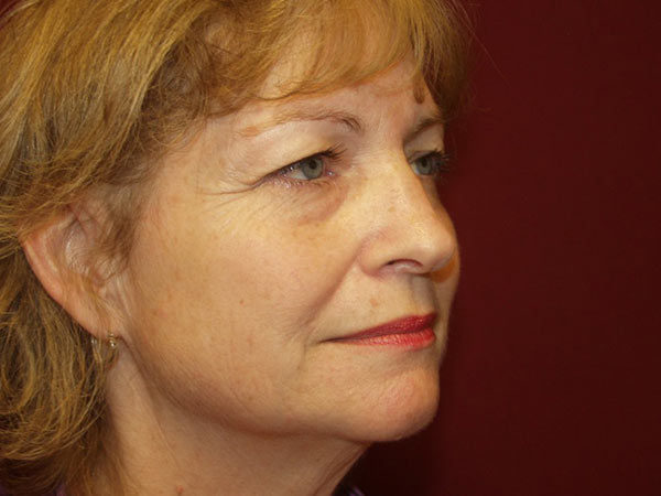 Eyelid Surgery Patient 21 Before 2