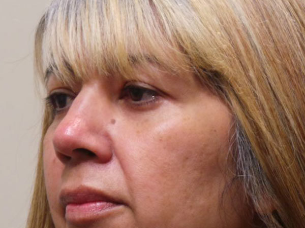 Eyelid Surgery Patient 03 After 1