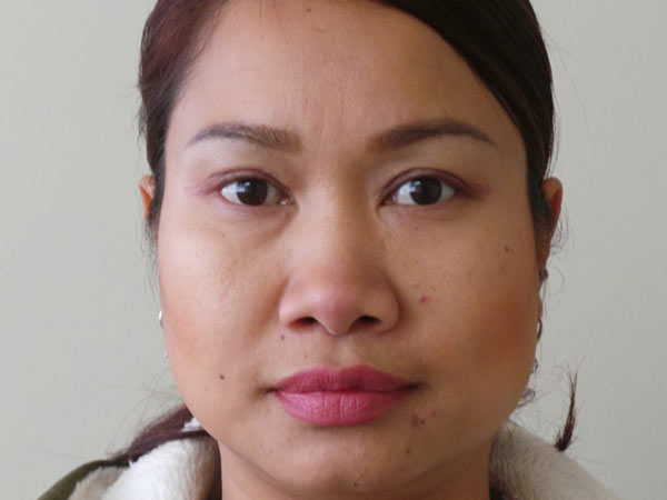 Eyelid Surgery Patient 04 After 1