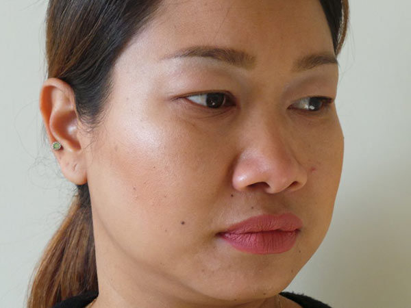 Eyelid Surgery Patient 04 Before 2