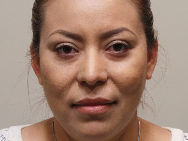 Eyelid Surgery Patient 06 After 2