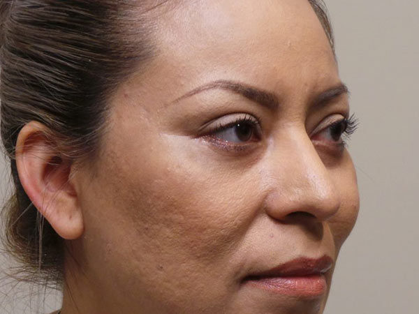 Eyelid Surgery Patient 06 After 1