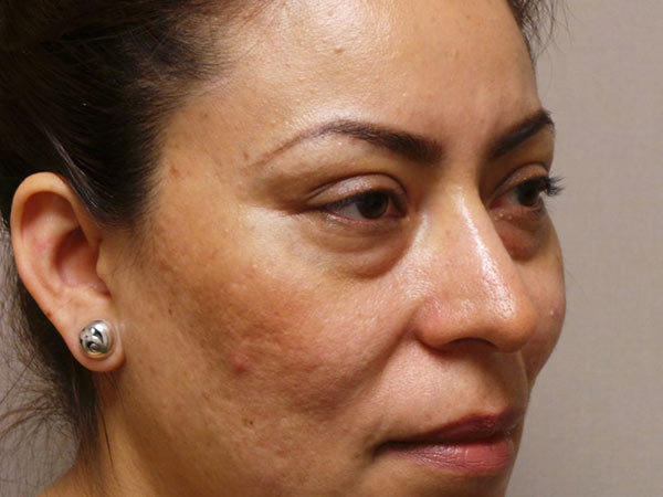 Eyelid Surgery Patient 06 Before 1