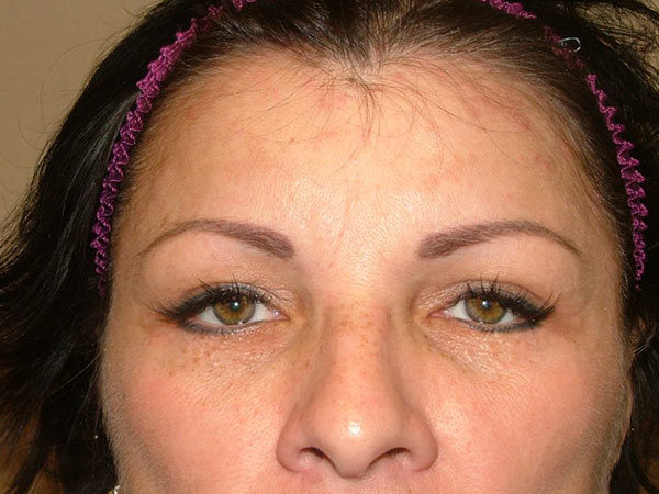 Eyelid Surgery Patient 07 After 2
