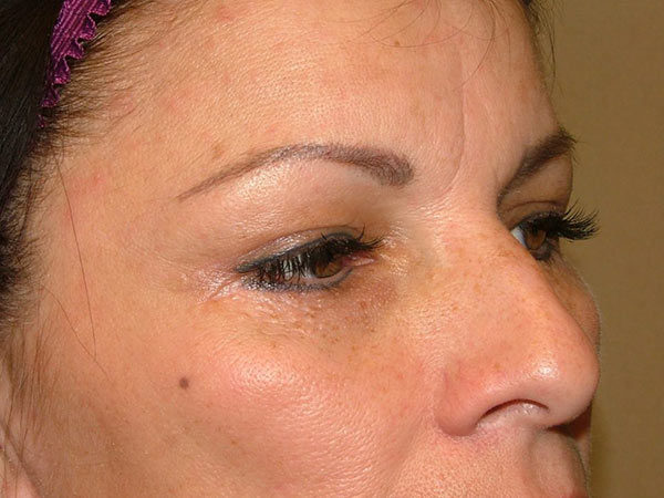 Eyelid Surgery Patient 07 After 1