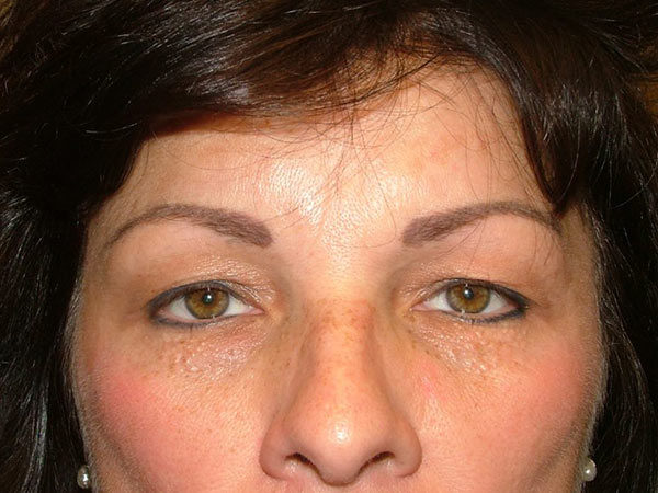 Eyelid Surgery Patient 07 Before 2