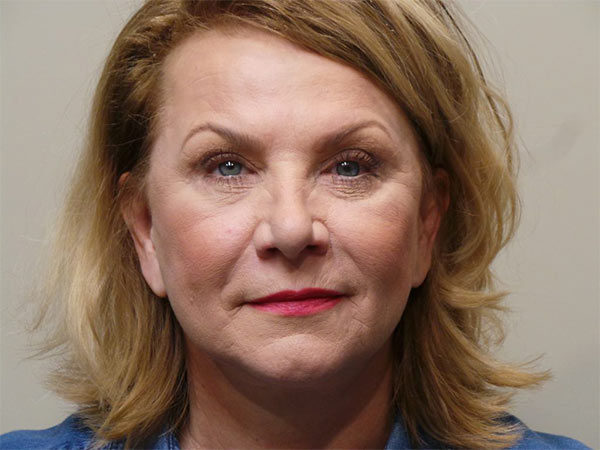 Eyelid Surgery Patient 08 After 1