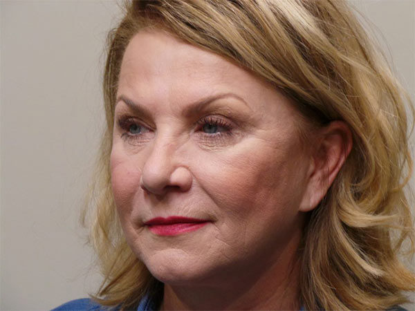 Eyelid Surgery Patient 08 After 2