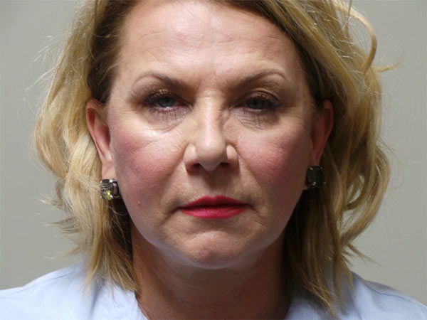 Eyelid Surgery Patient 08 Before 1