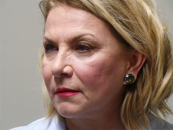 Eyelid Surgery Patient 08 Before 2