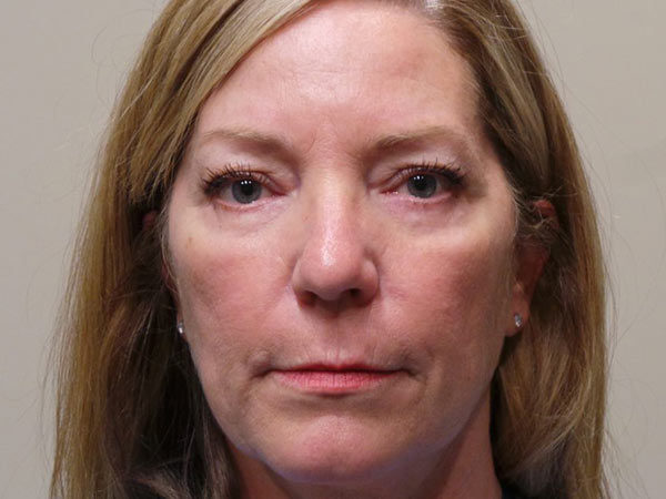 Eyelid Surgery Patient 09 After 1