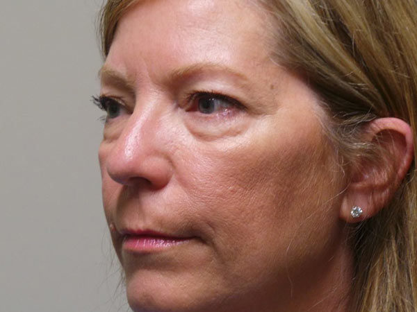 Eyelid Surgery Patient 09 Before 2