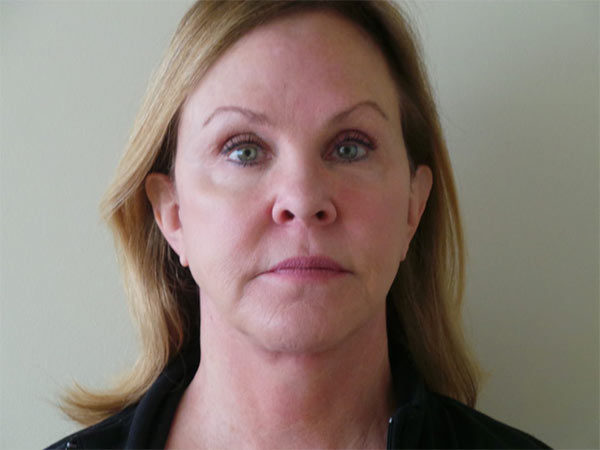 FaceLift Patient 01 After 1