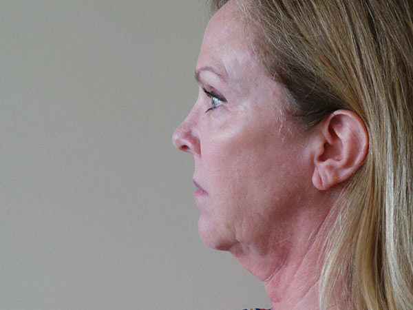 FaceLift Patient 01 Before 2