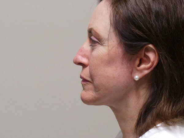 Facelift Patient 03 After 2