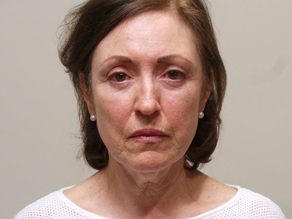 Facelift Patient 03 Before 1