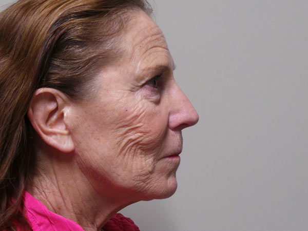 Facelift Patient 08 Before 2