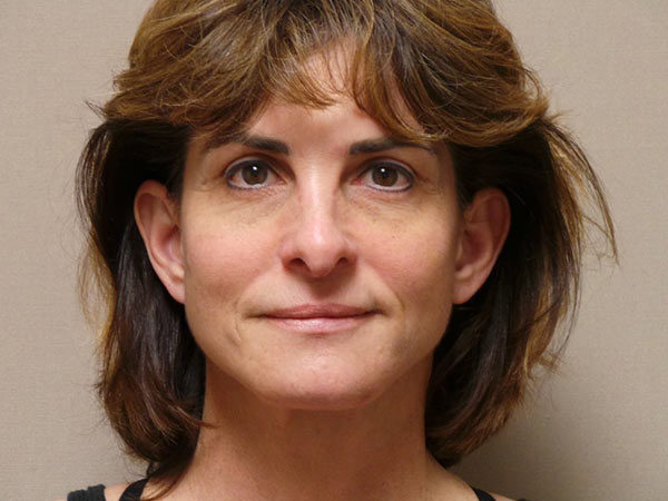 Facelift Patient 09 After 1