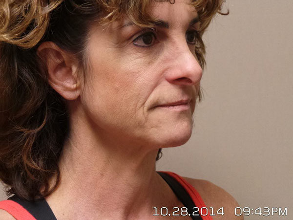 Facelift Patient 09 Before 2