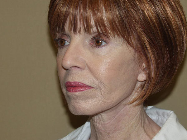 Facelift Patient 11 After 2